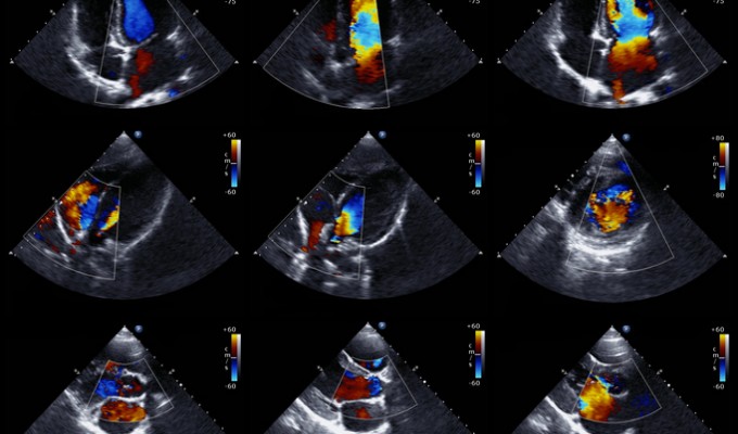 Atualização em Ecocardiografia e Cardiologia Fetal (CETRUS)